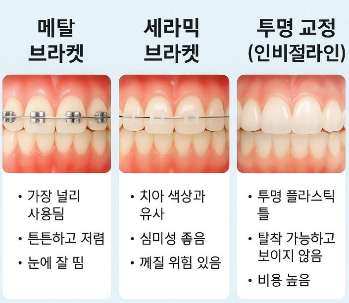 성장기 치아교정, 왜 빠르게 시작하는 것이 좋은지 알아보자 3 교정 장치의 종류