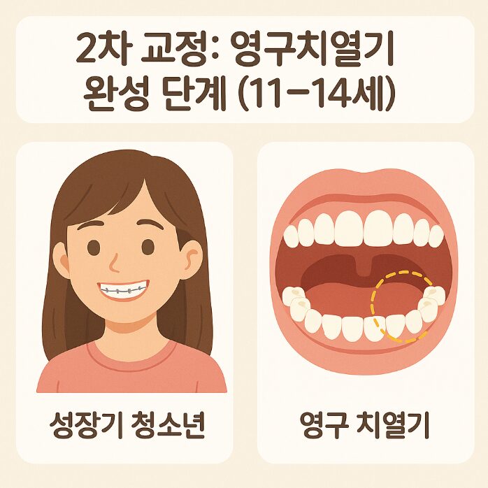 내 아이 치아교정, 언제 시작해야 할까? 시기별 교정 가이드 3 2차 교정